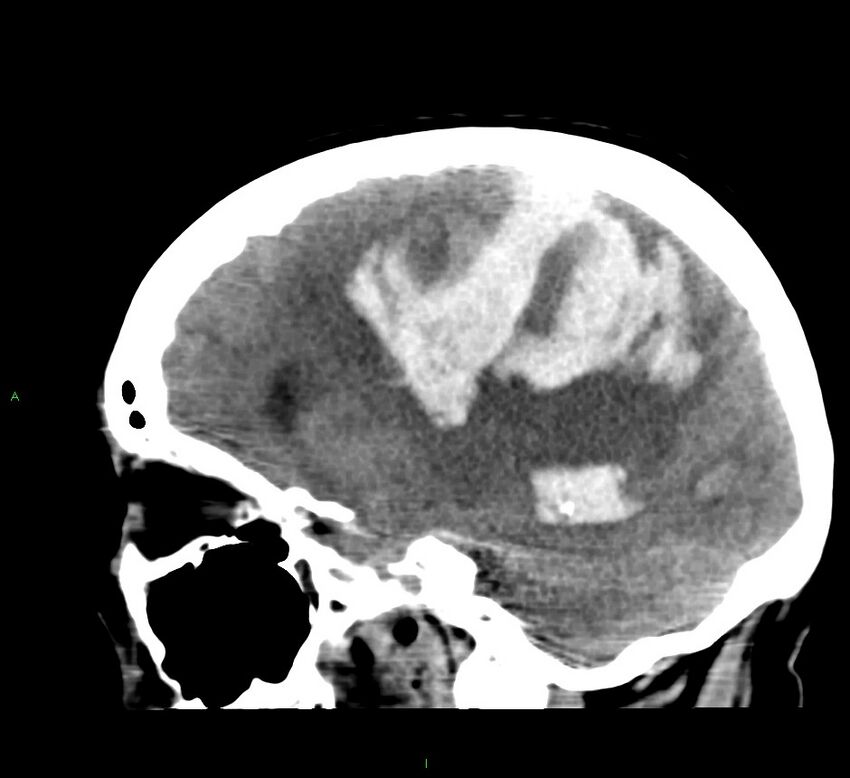 Cerebral amyloid angiopathy-associated lobar intracerebral hemorrhage (Radiopaedia 58379-65519 C 22).jpg