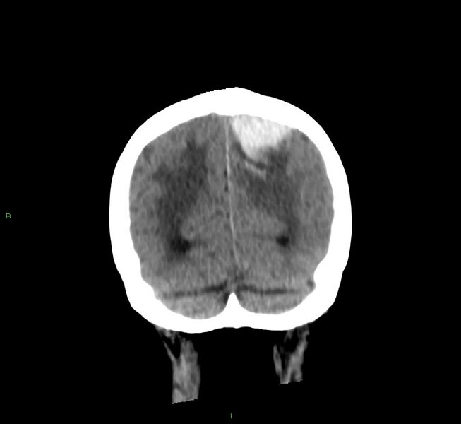 File:Cerebral amyloid angiopathy-associated lobar intracerebral hemorrhage (Radiopaedia 58530-65688 Coronal non-contrast 16).jpg