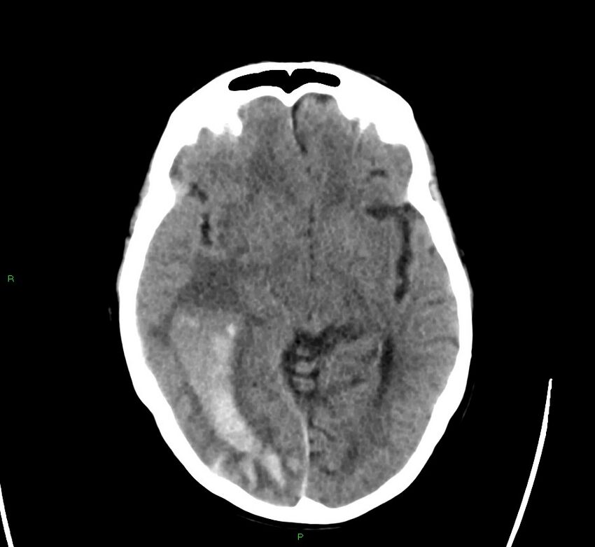 Cerebral amyloid angiopathy-associated lobar intracerebral hemorrhage (Radiopaedia 58563-65727 Axial non-contrast 32).jpg