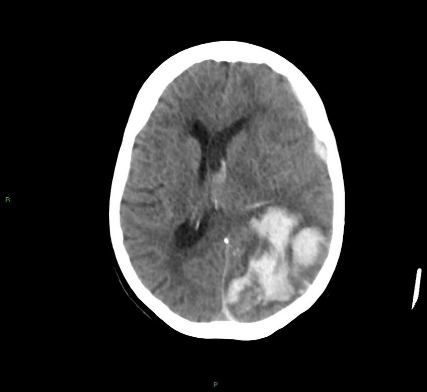 Cerebral amyloid angiopathy-associated lobar intracerebral hemorrhage (Radiopaedia 58754-65975 Axial non-contrast 31).jpg