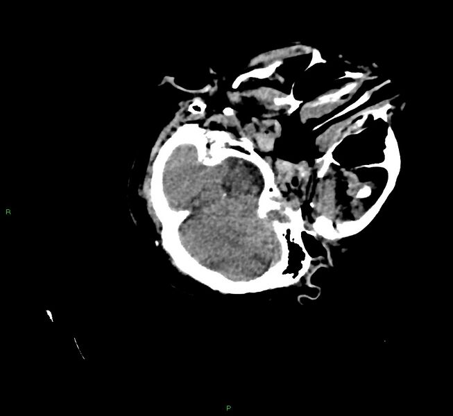 File:Cerebral amyloid angiopathy-associated lobar intracerebral hemorrhage (Radiopaedia 58757-65979 Axial non-contrast 27).jpg
