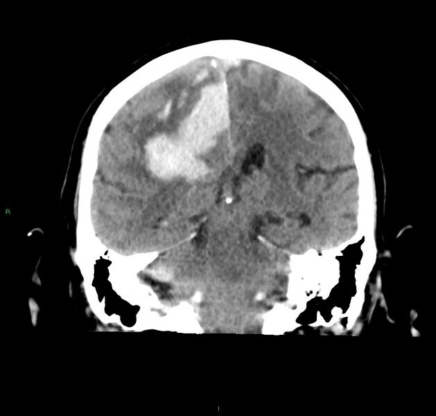 File:Cerebral amyloid angiopathy-associated lobar intracerebral hemorrhage (Radiopaedia 59356-66716 Coronal non-contrast 29).jpg