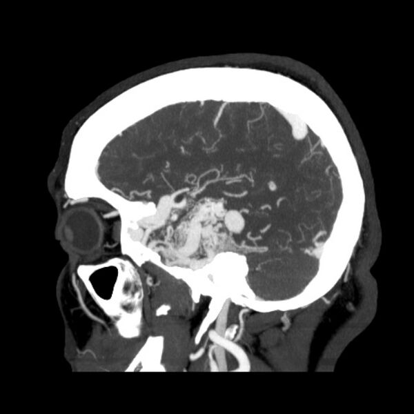 File:Cerebral arteriovenous malformation (Radiopaedia 43729-47189 D 38).jpg