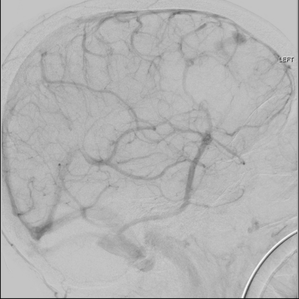 File:Cerebral arteriovenous malformation with lobar hemorrhage (Radiopaedia 44725-48513 LT CCA IC 41).png