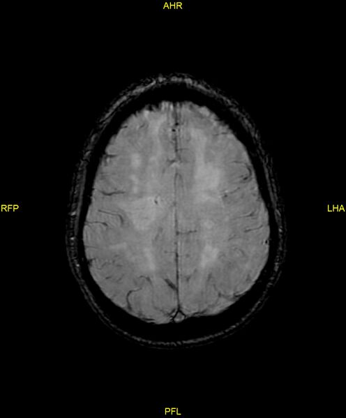 File:Cerebral autosomal dominant arteriopathy with subcortical infarcts and leukoencephalopathy (CADASIL) (Radiopaedia 86108-102054 Axial SWI 78).jpg