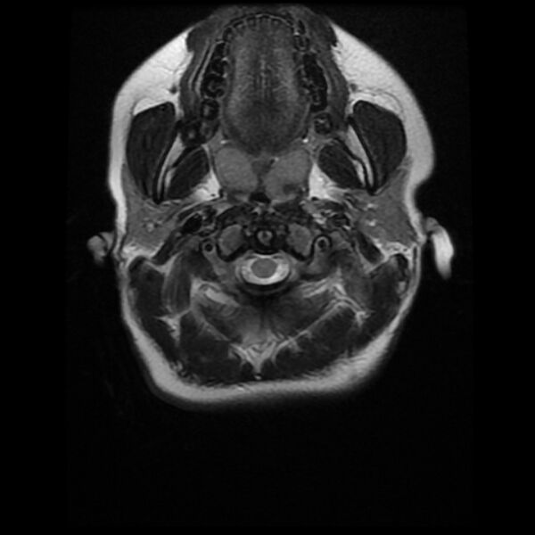 File:Cerebral cavernous malformation (Radiopaedia 44301-47942 Axial T2 1).jpg