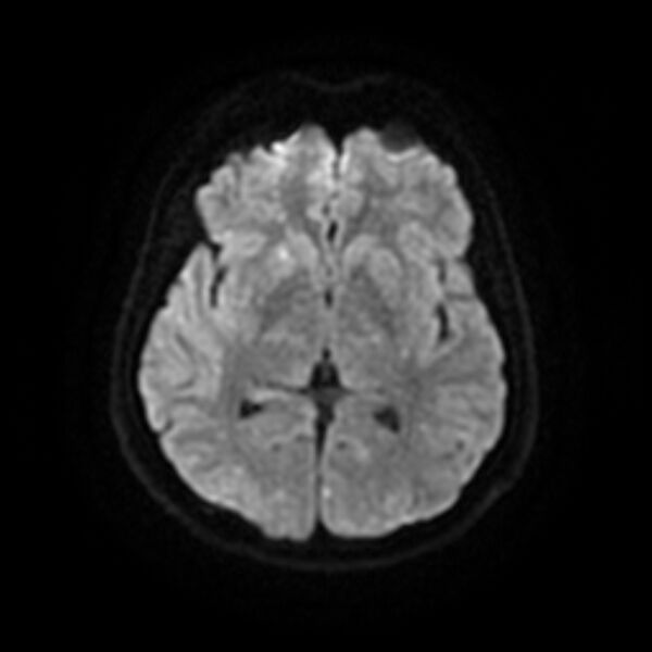 File:Cerebral fat embolism (Radiopaedia 37510-39363 Axial DWI 14).jpg