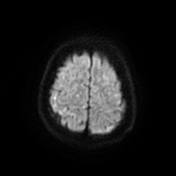 File:Cerebral fat embolism (Radiopaedia 37510-39363 Axial DWI 22).jpg