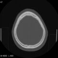 Cerebral hemorrhagic contusion with subdural and subarachnoid hemorrhage (Radiopaedia 10680-11146 Axial bone window 20).jpg