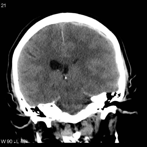 File:Cerebral hemorrhagic contusion with subdural and subarachnoid hemorrhage (Radiopaedia 10680-11146 Coronal non-contrast 11).jpg