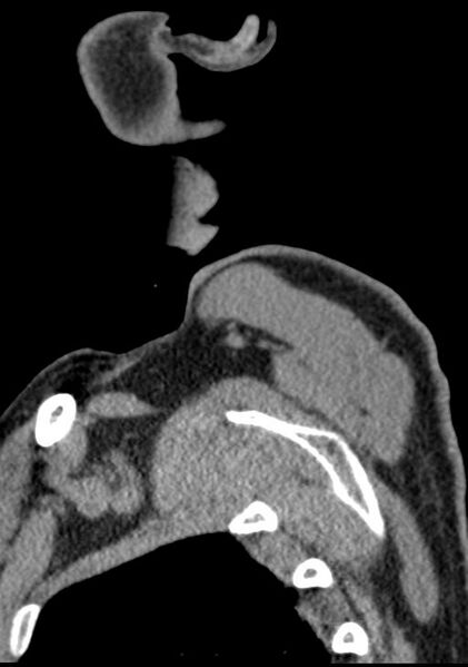 File:Cerebral hemorrhagic contusions and cervical spine fractures (Radiopaedia 32865-33841 G 3).jpg
