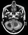 Cerebral metastases - small cell lung cancer (Radiopaedia 3972-6521 Axial FLAIR 1).jpg