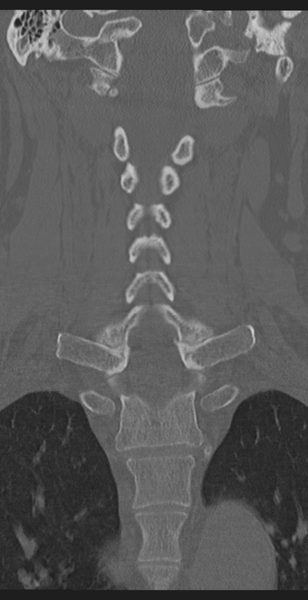 File:Cervical canal stenosis - OPLL and osteophytes (Radiopaedia 47329-51910 Coronal bone window 33).png