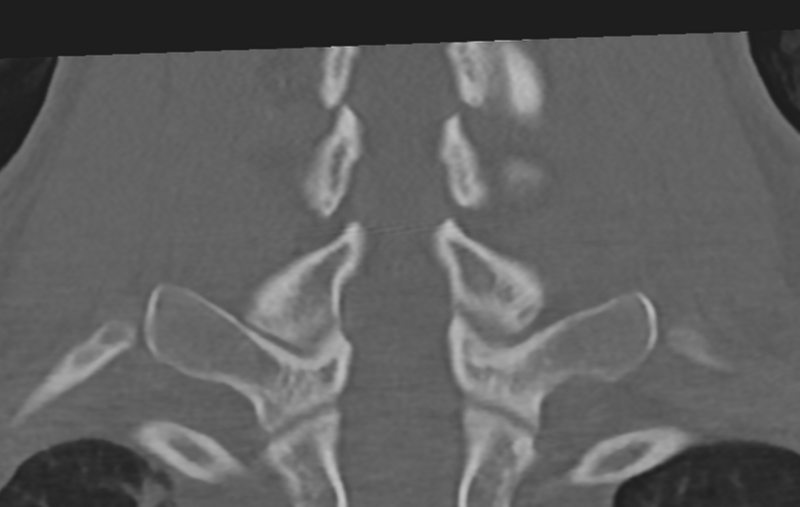 File:Cervical disc replacement (Radiopaedia 37383-39205 Coronal bone window 44).png
