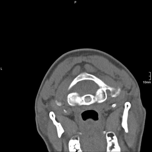 File:Cervical dural CSF leak on MRI and CT treated by blood patch (Radiopaedia 49748-54996 Axial non-contrast 1).jpg