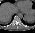 Cervical dural CSF leak on MRI and CT treated by blood patch (Radiopaedia 49748-54996 B 73).png