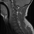 Cervical flexion teardrop fracture with cord hemorrhage (Radiopaedia 32497-33455 Sagittal T1 6).jpg