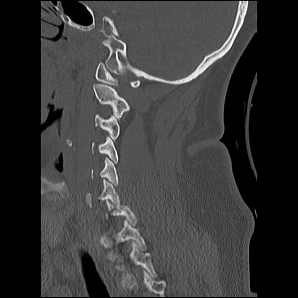 File:Cervical fracture and dislocation with locked facet (Radiopaedia 31837-32780 Sagittal bone window 9).jpg