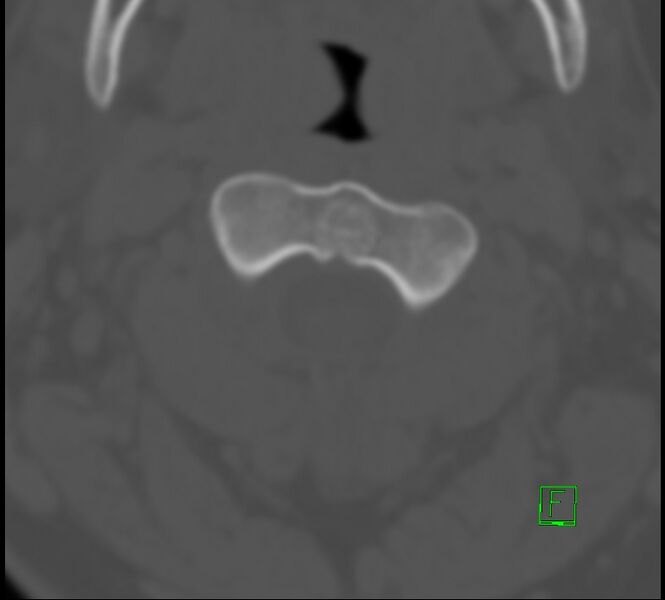 File:Cervical spine fracture - hyperflexion injury (Radiopaedia 66184-75364 Axial bone window 5).jpg