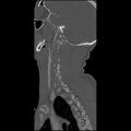Cervical spine fractures with vertebral artery dissection (Radiopaedia 32135-33078 Sagittal bone window 7).jpg