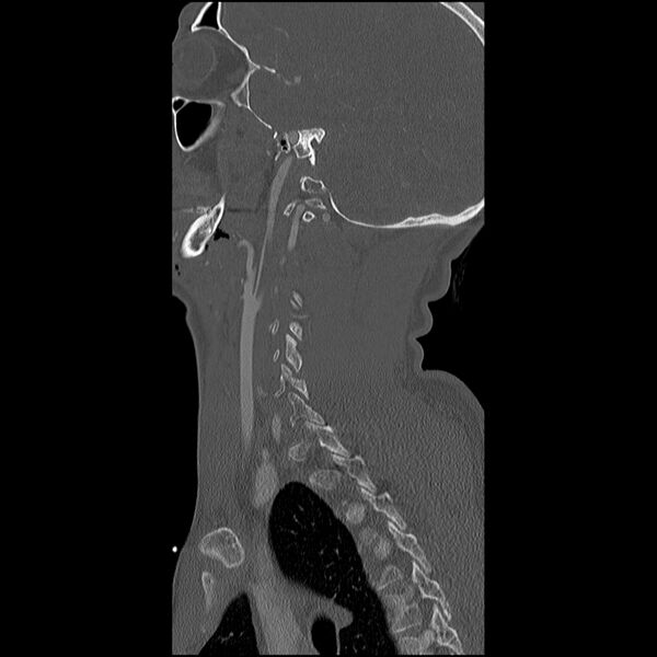 File:Cervical spine fractures with vertebral artery dissection (Radiopaedia 32135-33078 Sagittal bone window 7).jpg