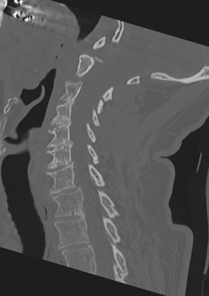File:Cervical spine fractures with vertebral artery dissection (Radiopaedia 53296-59268 Sagittal bone window 29).png
