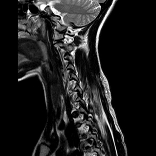 File:Cervical spine posterior ligamentous complex rupture (Radiopaedia 63486-72103 Sagittal T2 11).jpg