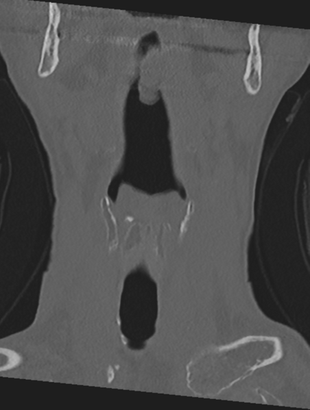 File:Cervical spondylolysis (Radiopaedia 49616-54811 Coronal bone window 2).png