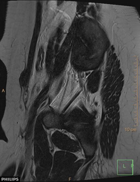 File:Cesarian scar endometriosis (Radiopaedia 68495-78066 Sagittal T2 26).jpg