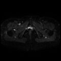 Cesarian section scar endometriosis (Radiopaedia 66520-75799 Axial DWI 24).jpg
