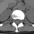 Chance fracture (Radiopaedia 36521-38081 Axial non-contrast 62).jpg