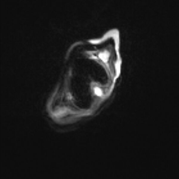 File:Chiari III malformation with occipital encephalocele (Radiopaedia 79446-92559 Axial DWI 1).jpg