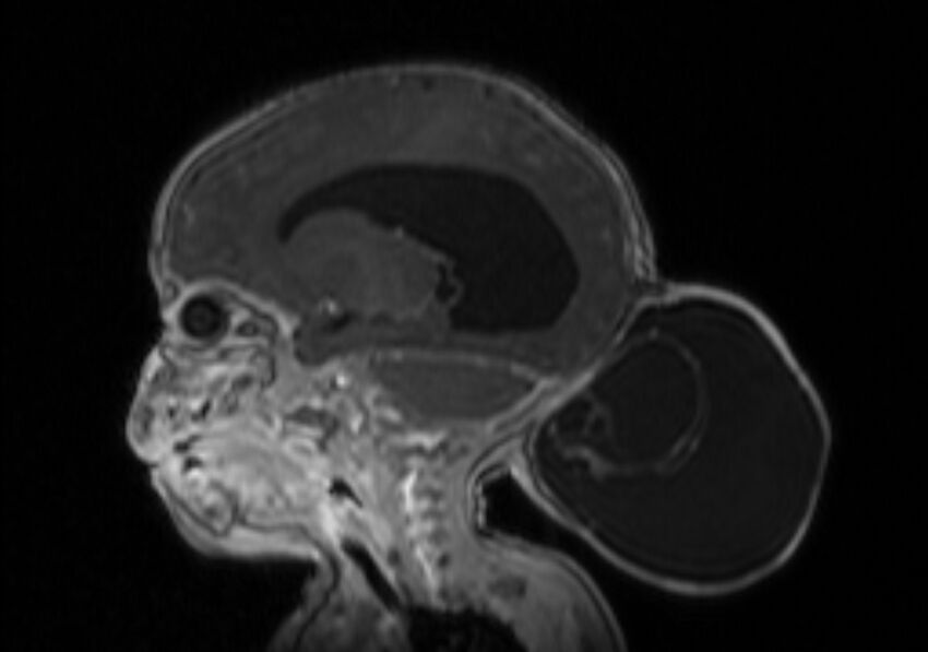 Chiari III malformation with occipital encephalocele (Radiopaedia 79446-92559 Sagittal T1 C+ mpr 29).jpg
