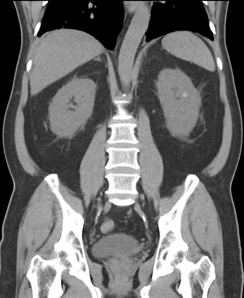 File:Cholecystitis with focal perforation and hepatic abscess (Radiopaedia 37189-38945 Coronal non-contrast 38).png
