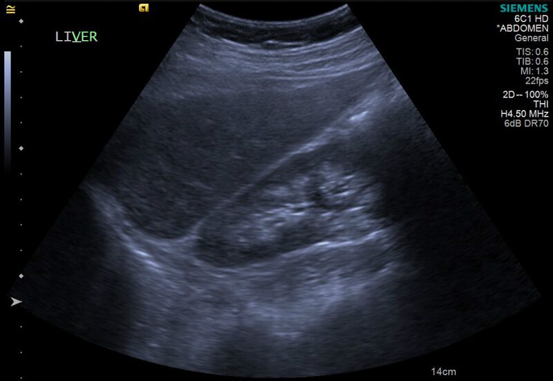 File:Cholelithiasis with biliary dilatation (Radiopaedia 49442-54588 A 5).jpg