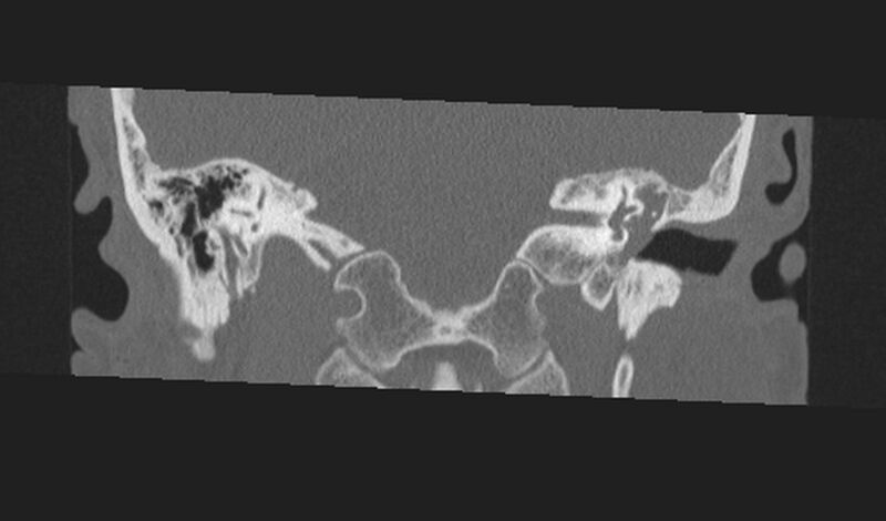 File:Cholesteatoma (Radiopaedia 10742-11203 Coronal bone window 15).jpg
