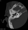 Cholesteatoma (Radiopaedia 5467-7197 Axial bone window 3).jpg