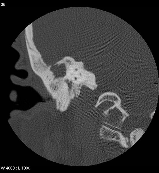 File:Cholesteatoma (Radiopaedia 5467-7197 Coronal bone window 21).jpg