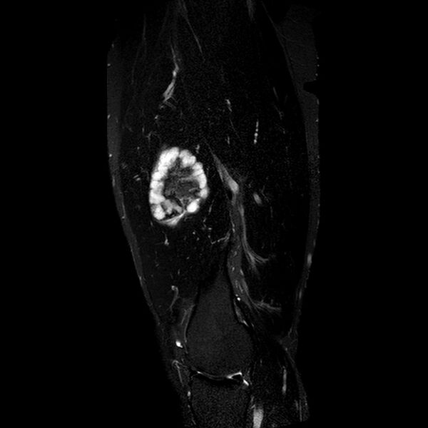 File:Chondrosarcoma arising from exostosis (Radiopaedia 59996-67686 Sagittal STIR 14).jpg