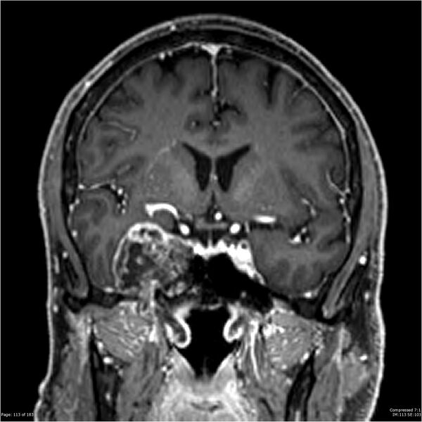 File:Chondrosarcoma of skull base- grade II (Radiopaedia 40948-43654 Coronal T1 C+ 24).jpg