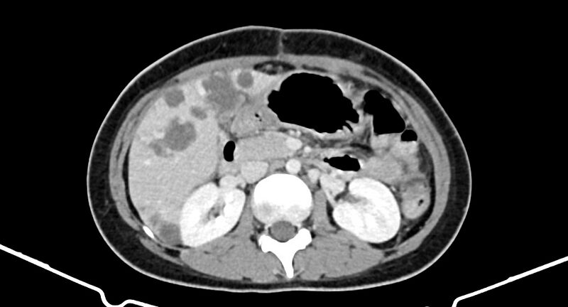 File:Choriocarcinoma liver metastases (Radiopaedia 74768-85766 A 93).jpg
