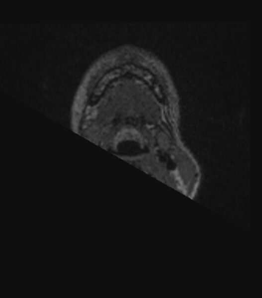 File:Choroid plexus carcinoma (Radiopaedia 91013-108553 Axial FLAIR C+ 16).jpg