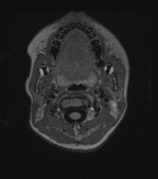 File:Choroid plexus carcinoma (Radiopaedia 91013-108553 Axial FLAIR C+ 48).jpg