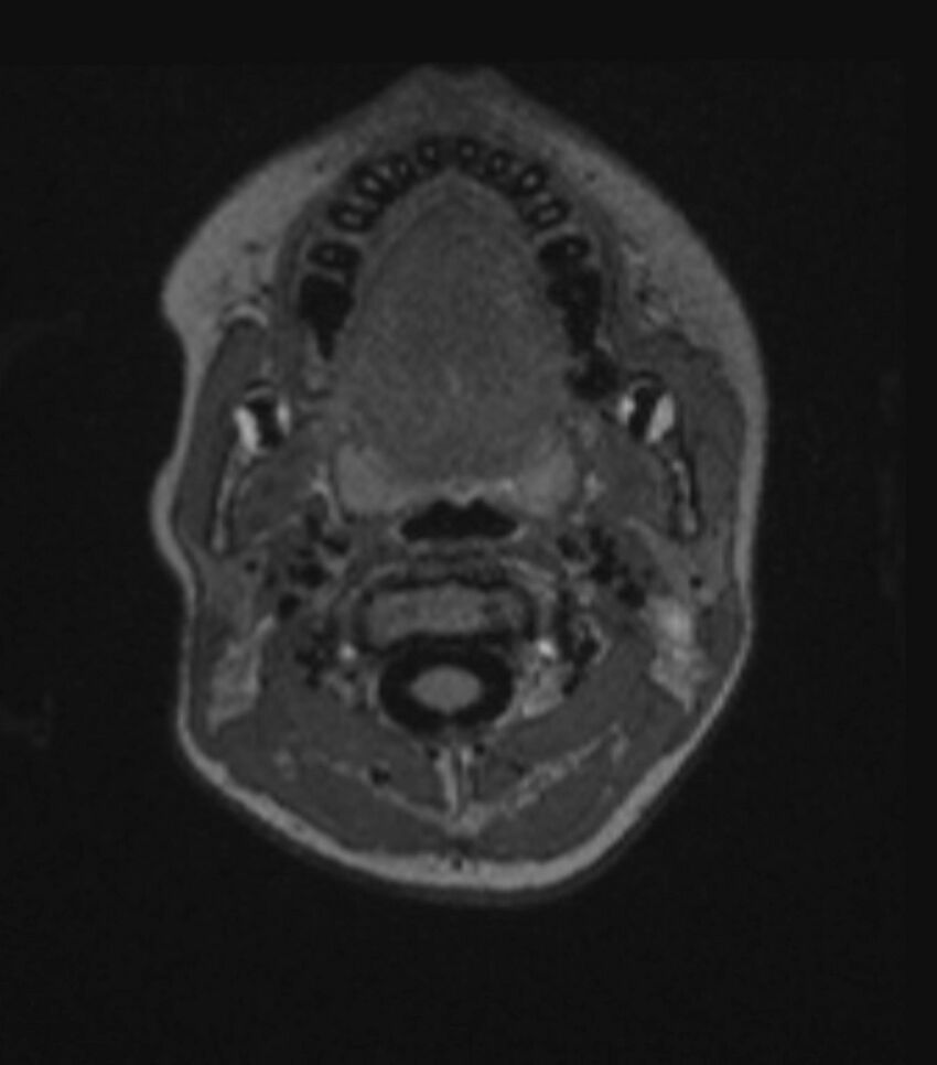 Choroid plexus carcinoma (Radiopaedia 91013-108553 Axial FLAIR C+ 48).jpg