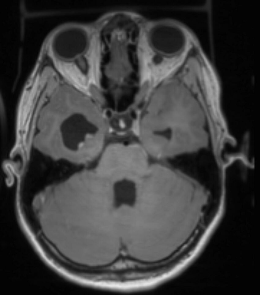 Choroid plexus carcinoma (Radiopaedia 91013-108553 Axial T1 C+ 105).jpg