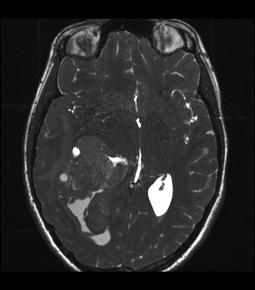 Choroid plexus carcinoma (Radiopaedia 91013-108553 Axial T2 CISS 36).jpg