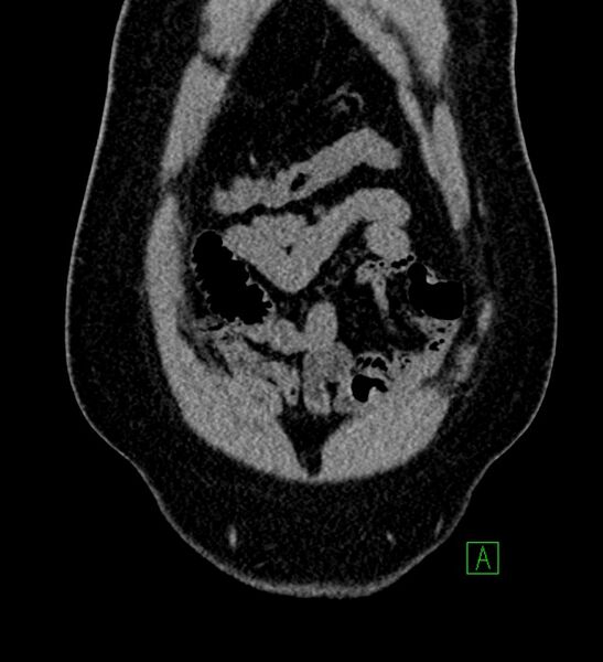 File:Chromophobe renal cell carcinoma (Radiopaedia 84286-99573 Coronal non-contrast 21).jpg