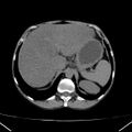 Chronic pancreatitis (Radiopaedia 23132-23172 Axial non-contrast 18).jpg