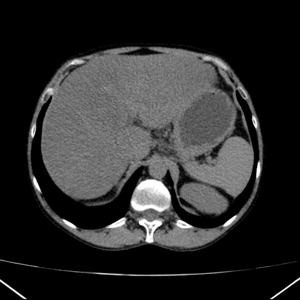 File:Chronic pancreatitis (Radiopaedia 23132-23172 Axial non-contrast 18).jpg