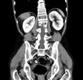 Chronic pancreatitis (Radiopaedia 23132-23172 C 44).jpg